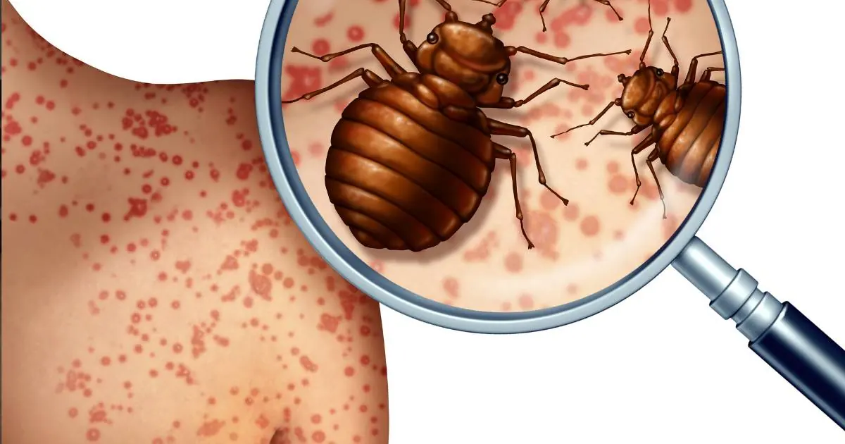 Bed Bug Bites: How to Identification and Treatment in 2023