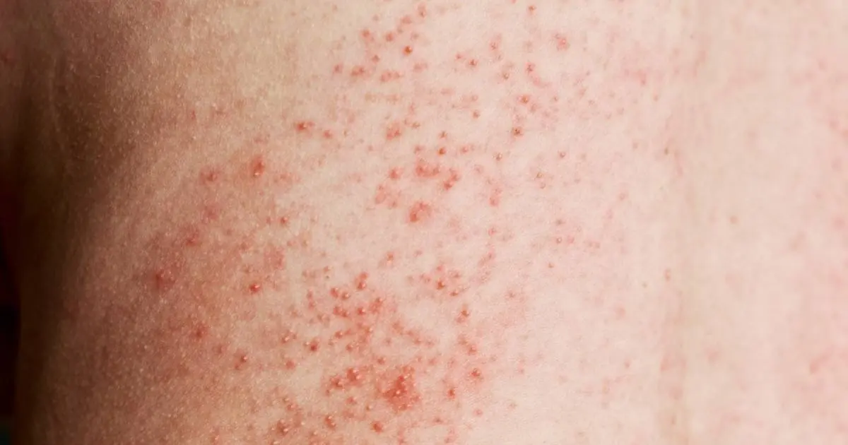 Skin Rashes